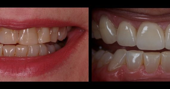 Faccette dentali