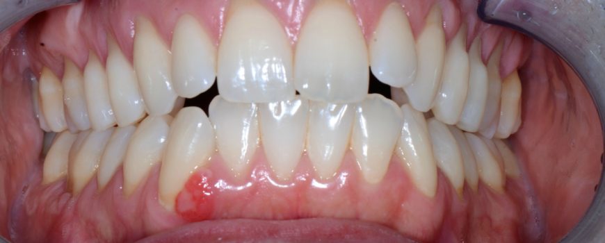 Colletti dei denti scoperti: cause e possibili rimedi