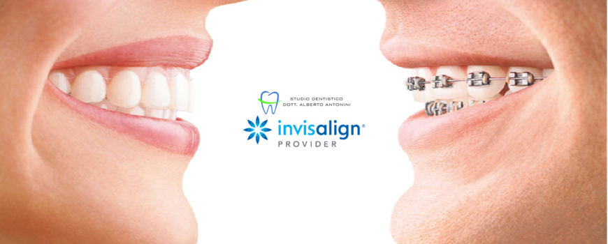 Invisalign